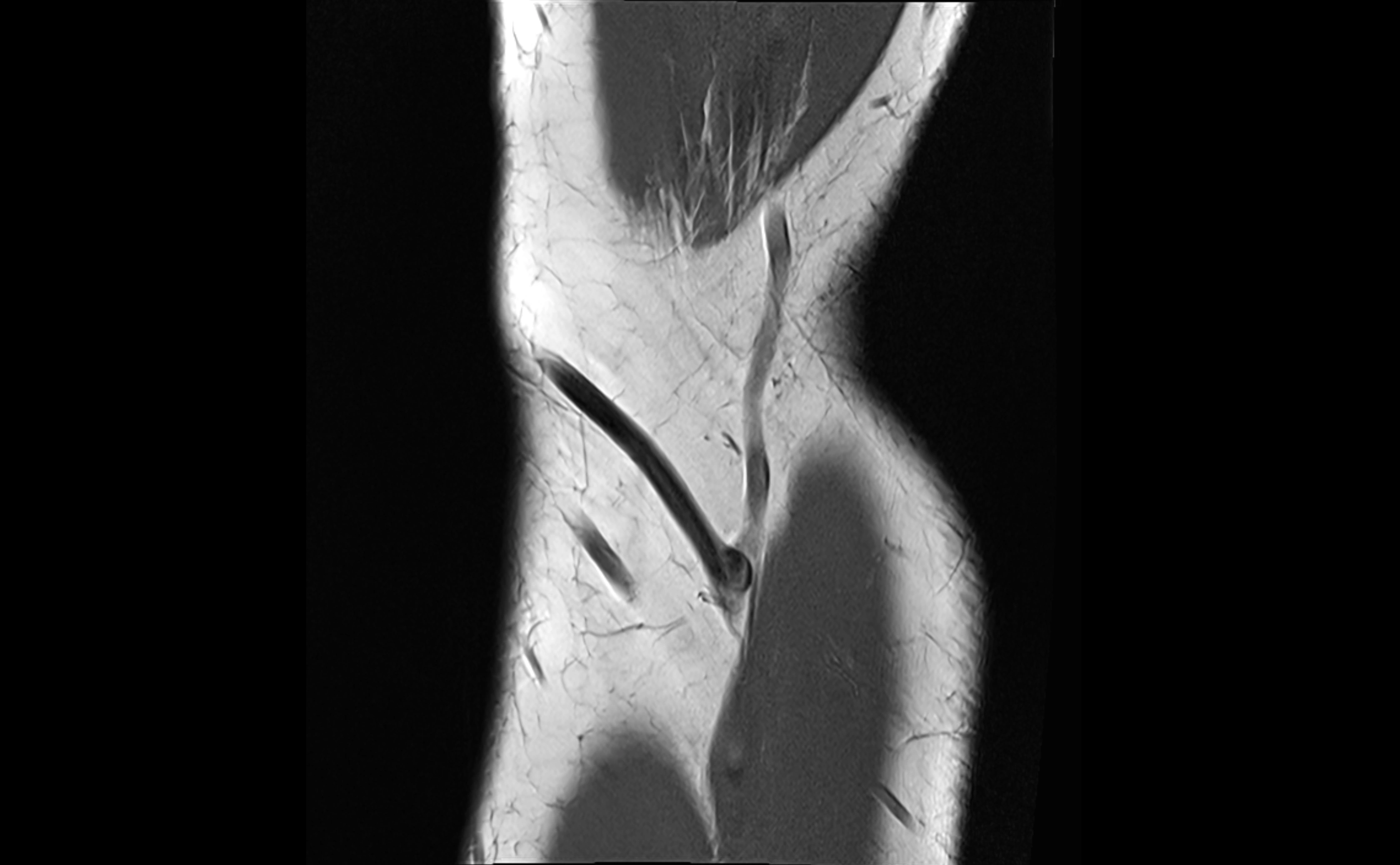 MRI elbow ligaments coronal cross sectional anatomy 3T  radiology  image-img-07001-00005.webp